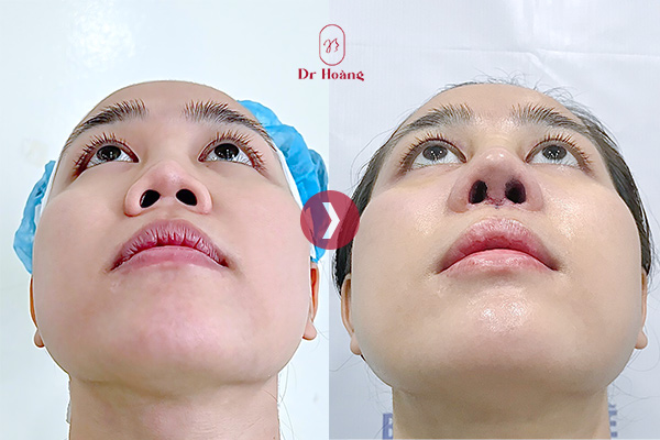 Mũi co rút do viêm nhiễm