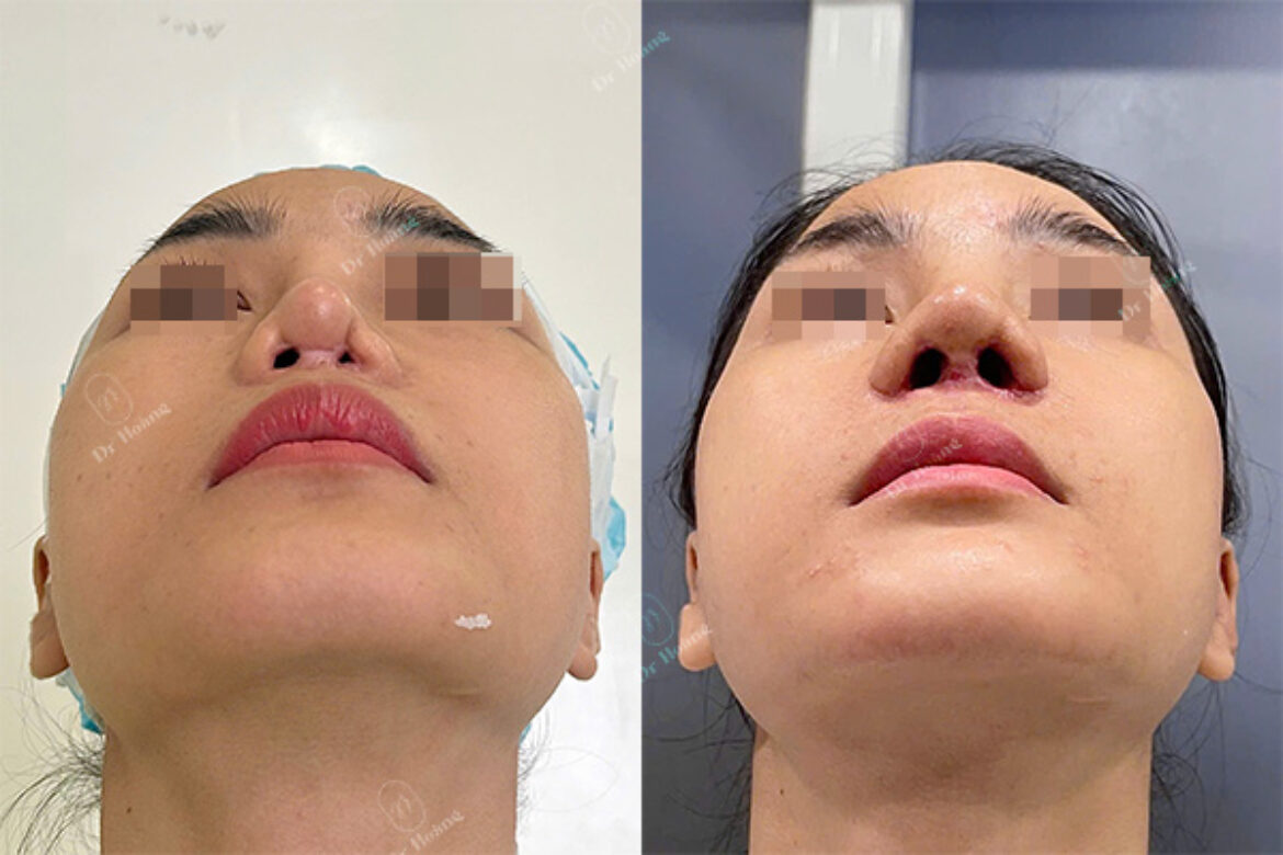 MCR21-seo-sau-nang-mui-1