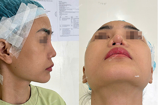 sẹo sau nâng mũi