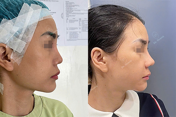 sẹo sau nâng mũi