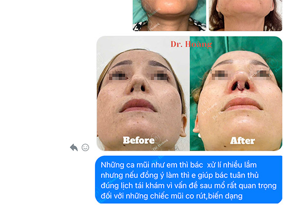 Hình ảnh kết quả điều trị chít hẹp lỗ mũi tại Dr.Hoàng