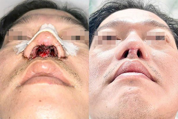 Nhiễm trùng sau nâng mũi