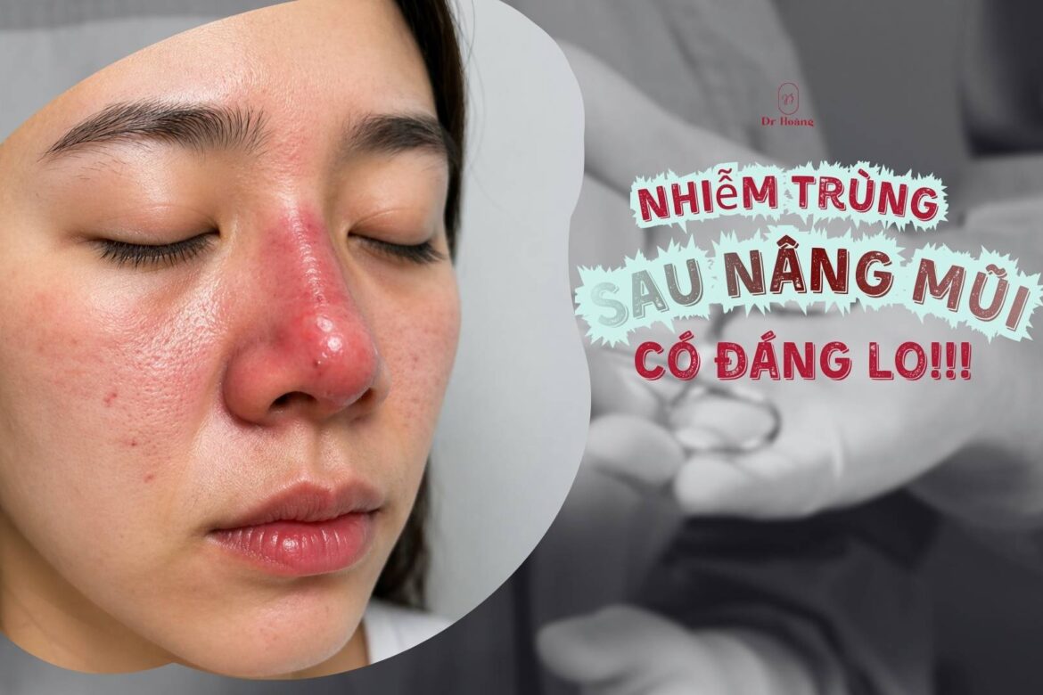 Nhiễm trùng sau nâng mũi