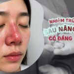 Nhiễm trùng sau nâng mũi