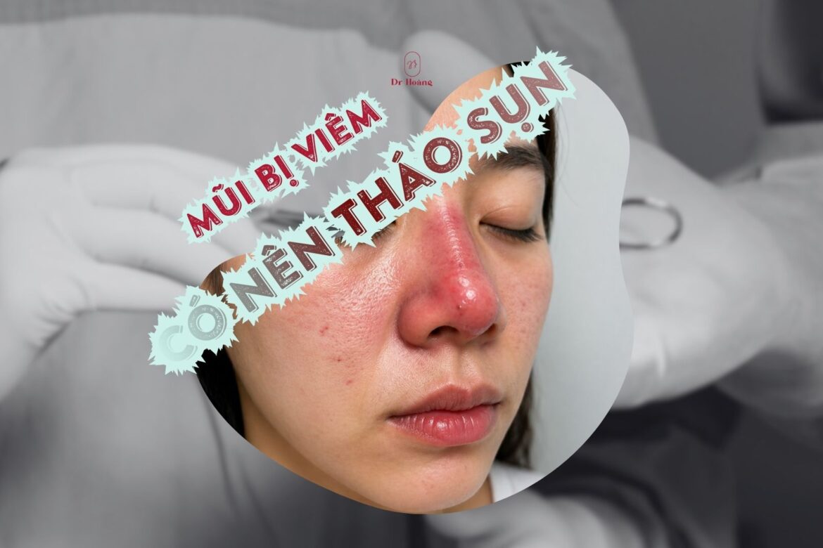 Mũi bị viêm có nên tháo sụn