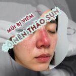 Mũi bị viêm có nên tháo sụn