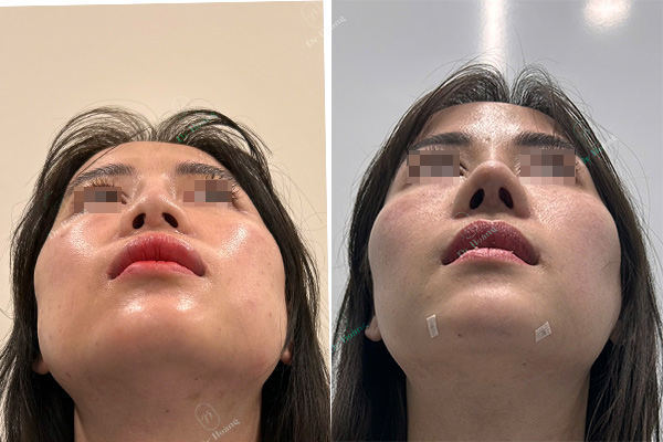 Đầu mũi cụp xuống, mũi co rút