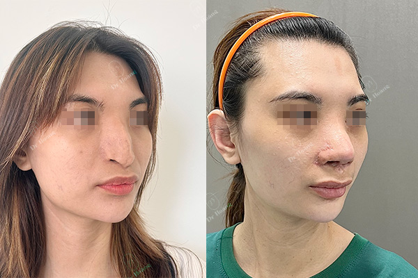 Mũi dị tật bẩm sinh